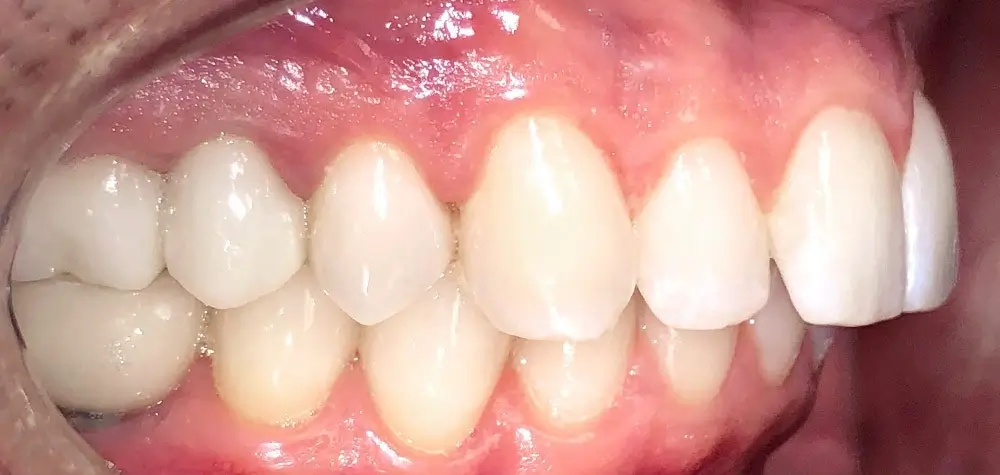 Перекрестный прикус - Кейс 9 — боковой ракурс до лечения