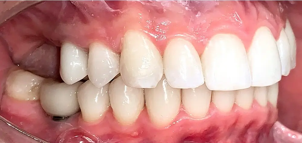 Перекрестный прикус - Кейс 9 — боковой ракурс после лечения