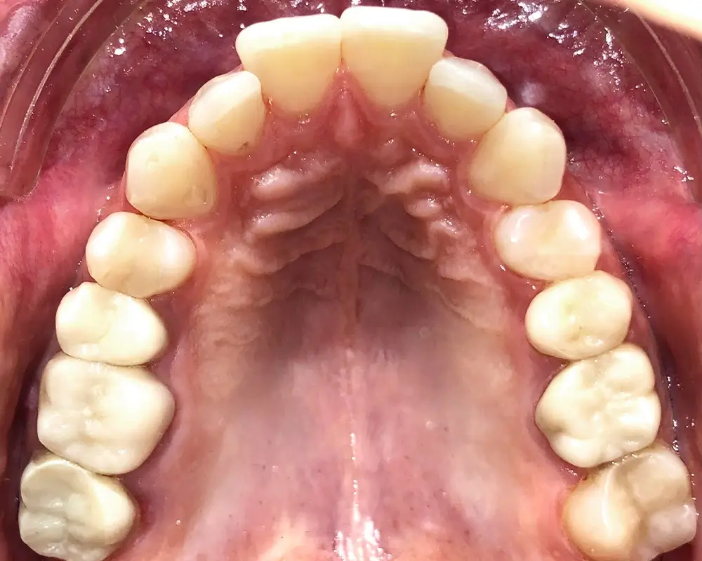 Перекрестный прикус - Кейс 9 — верхняя челюсть до лечения