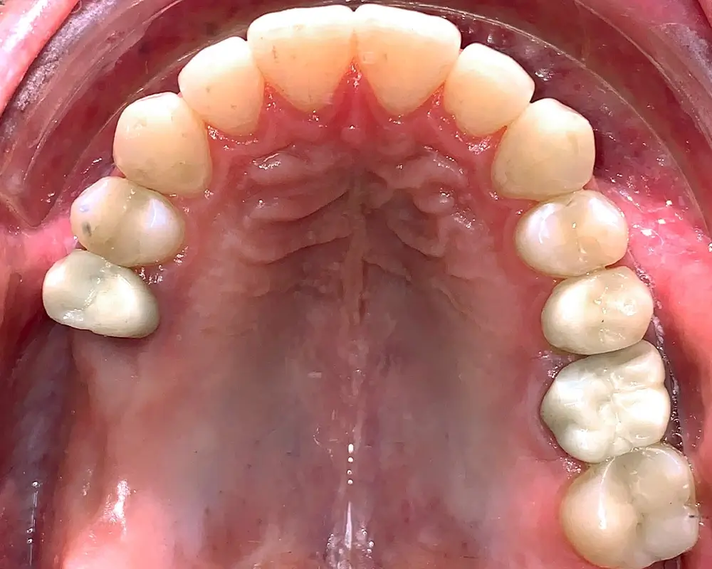 Перекрестный прикус - Кейс 9 — верхняя челюсть после лечения