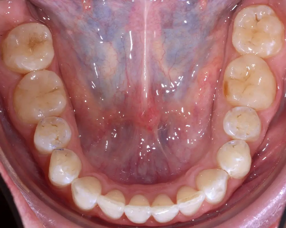 Скученность - Кейс 1 — нижняя челюсть после лечения