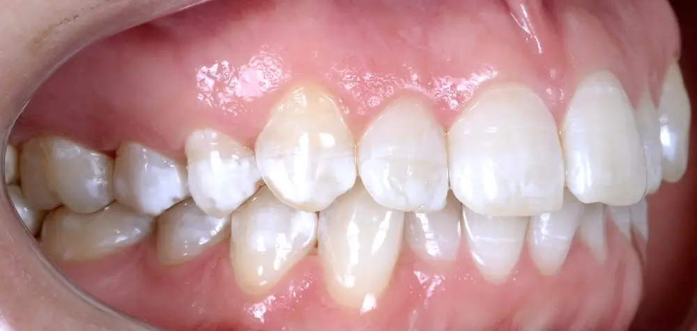 Скученность - Кейс 1 — боковой ракурс до лечения