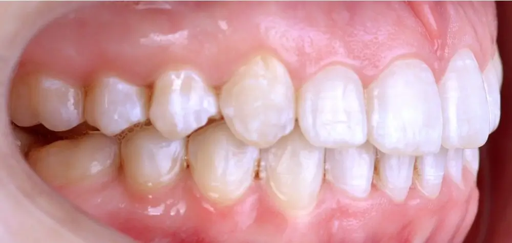 Скученность - Кейс 1 — боковой ракурс после лечения