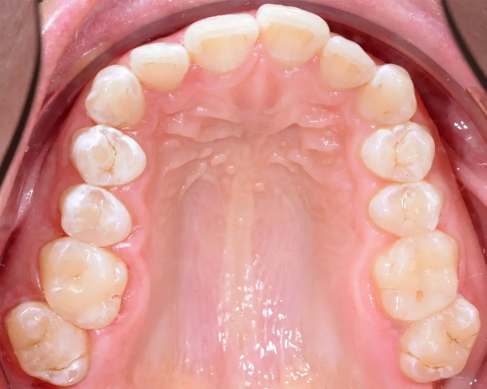 Скученность - Кейс 1 — верхняя челюсть до лечения