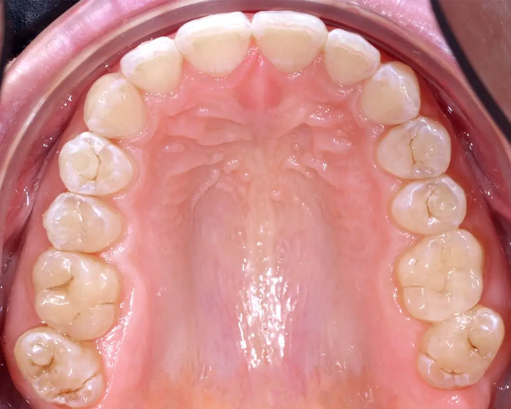 Скученность - Кейс 1 — верхняя челюсть после лечения