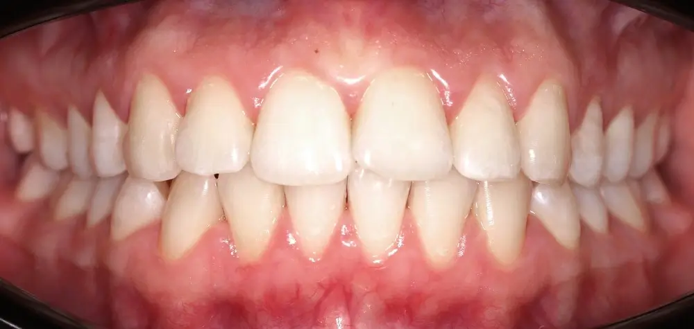 Скученность - Кейс 10 — вид спереди до лечения