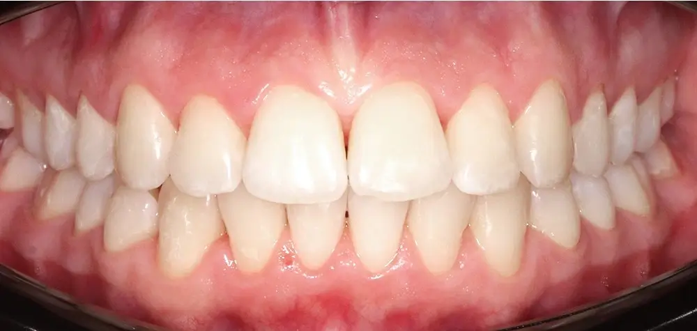 Скученность - Кейс 10 — вид спереди после лечения