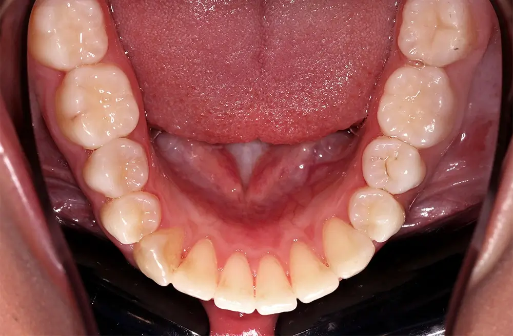 Скученность - Кейс 10 — нижняя челюсть до лечения