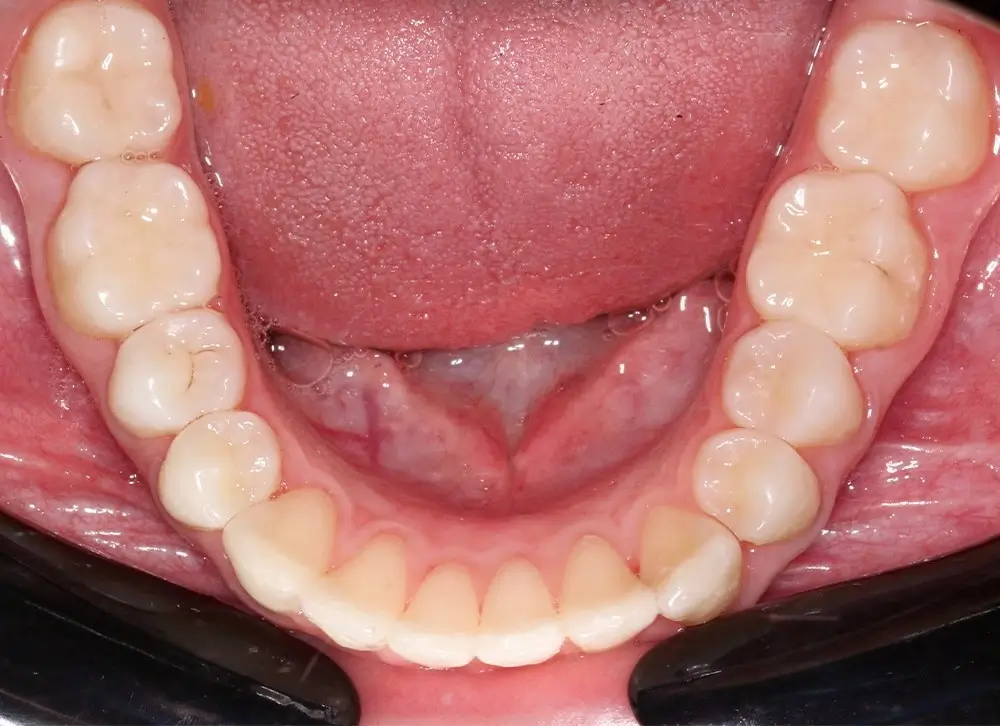 Скученность - Кейс 10 — нижняя челюсть после лечения