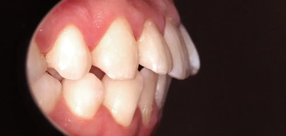 Скученность - Кейс 10 — боковой ракурс до лечения