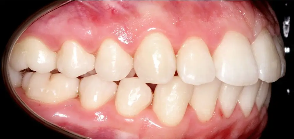 Скученность - Кейс 10 — боковой ракурс после лечения