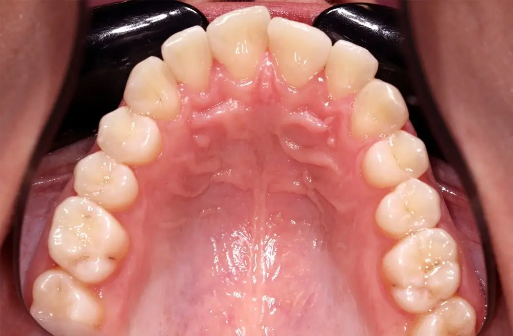 Скученность - Кейс 10 — верхняя челюсть до лечения