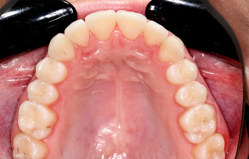 Скученность - Кейс 10 — верхняя челюсть после лечения