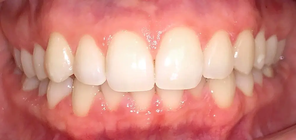 Скученность - Кейс 11 — вид спереди до лечения