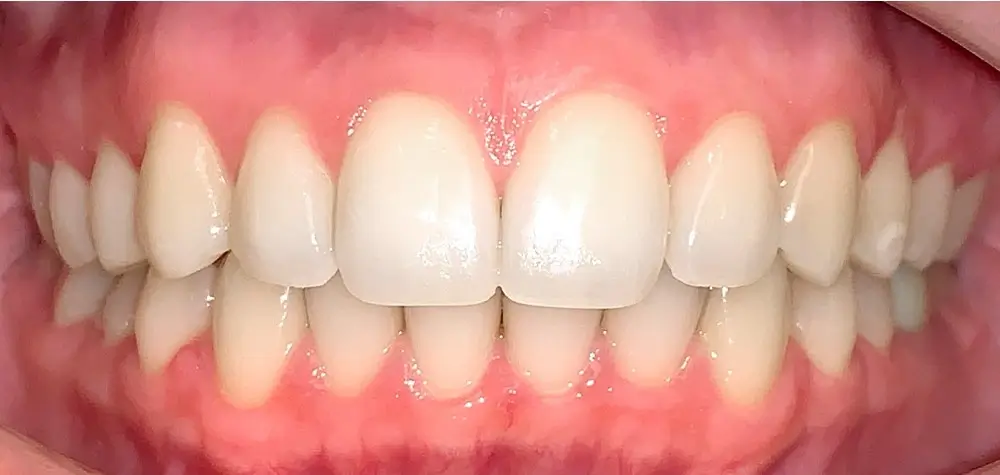 Скученность - Кейс 11 — вид спереди после лечения