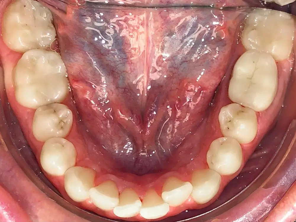 Скученность - Кейс 11 — нижняя челюсть до лечения