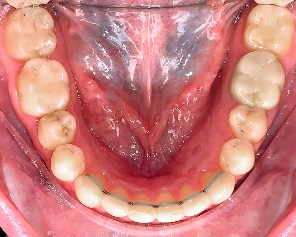 Скученность - Кейс 11 — нижняя челюсть после лечения