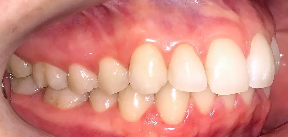 Скученность - Кейс 11 — боковой ракурс до лечения