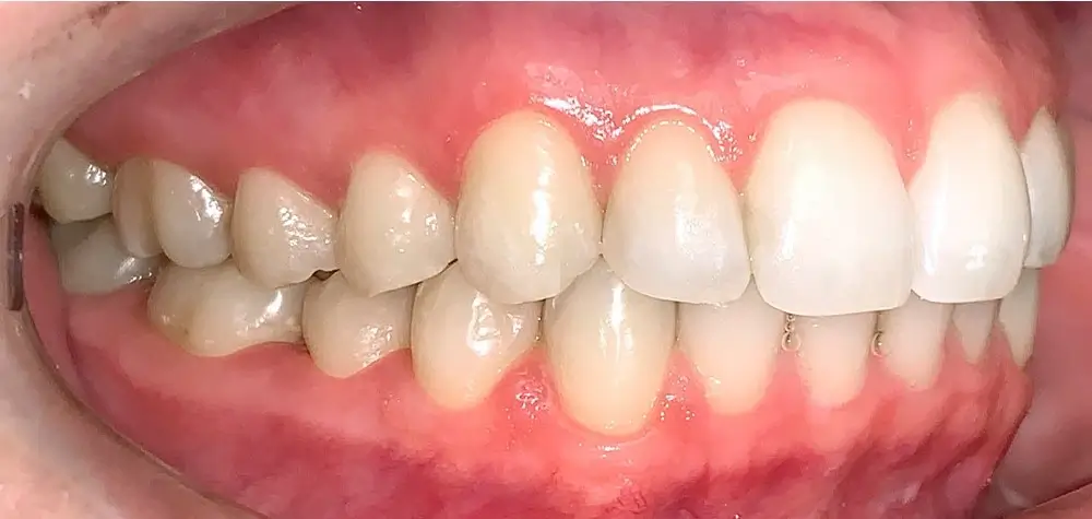 Скученность - Кейс 11 — боковой ракурс после лечения