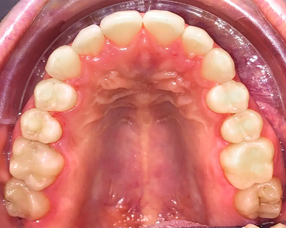 Скученность - Кейс 11 — верхняя челюсть до лечения