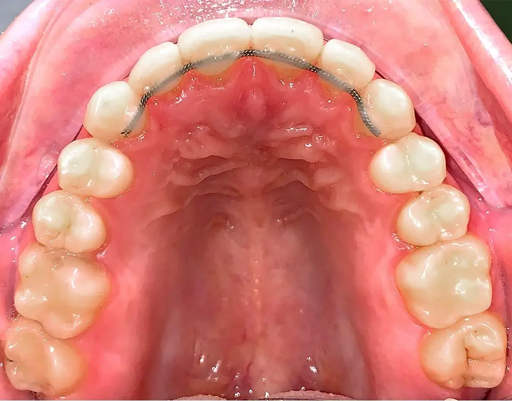 Скученность - Кейс 11 — верхняя челюсть после лечения