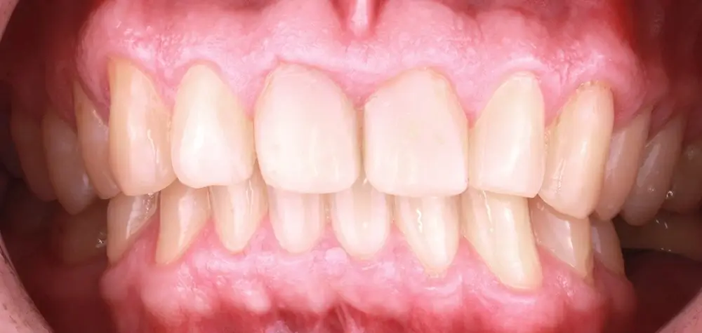 Скученность - Кейс 12 — фронтальный ракурс до лечения