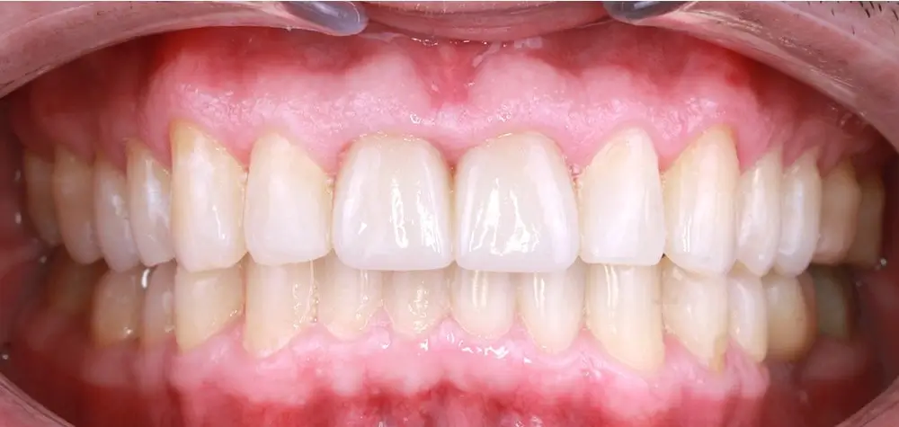 Скученность - Кейс 12 — фронтальный ракурс после лечения