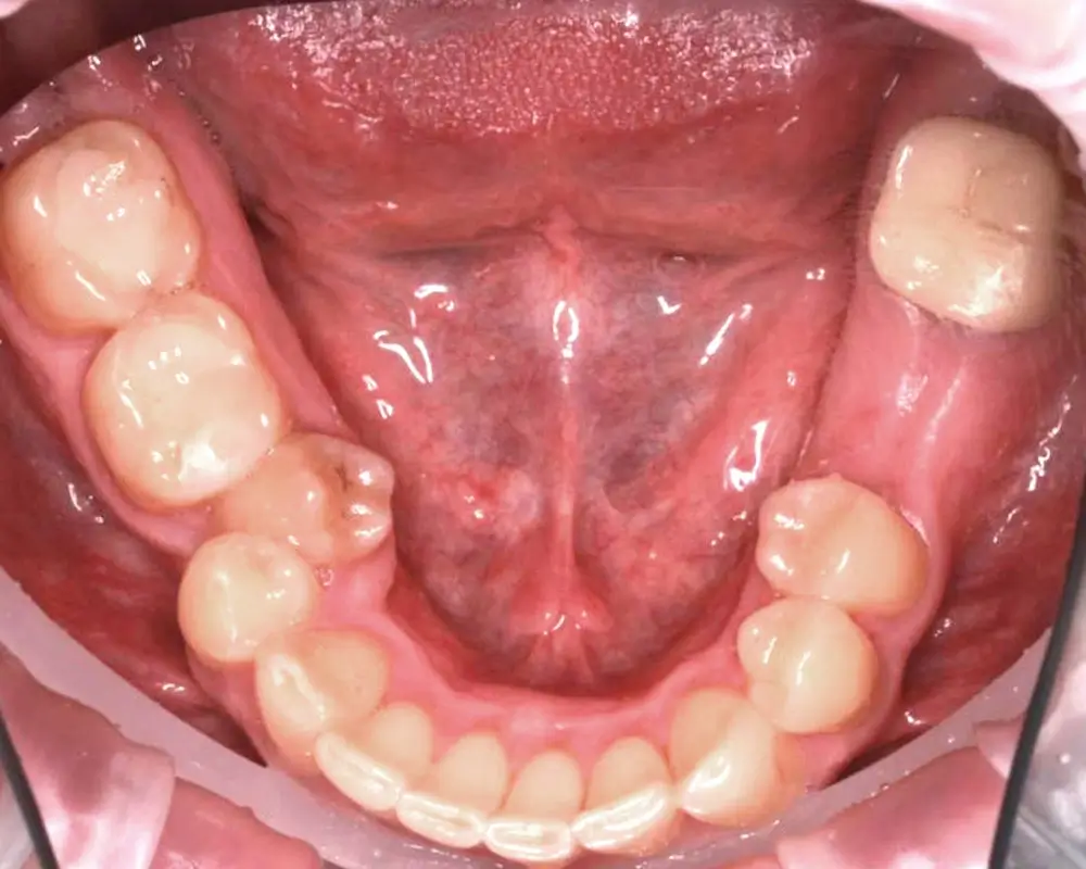 Скученность - Кейс 12 — нижняя челюсть до лечения