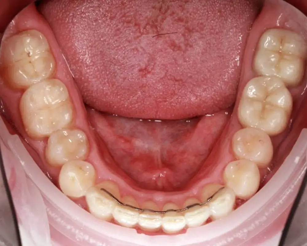 Скученность - Кейс 12 — нижняя челюсть после лечения