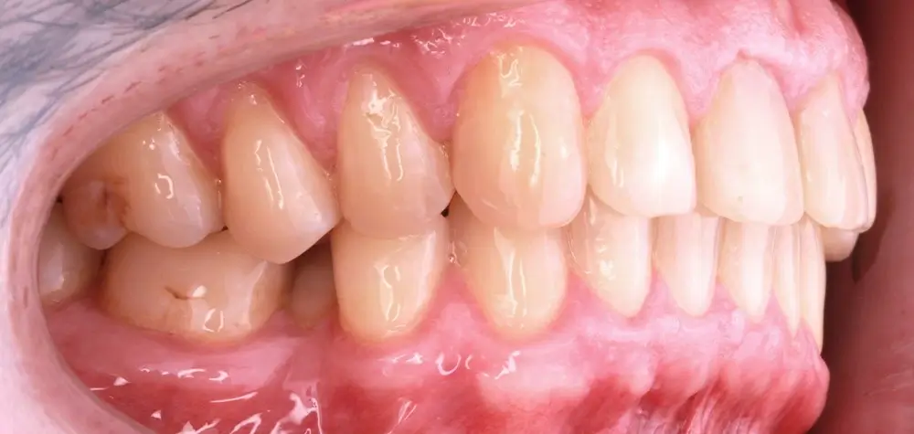 Скученность - Кейс 12 — боковой ракурс до лечения