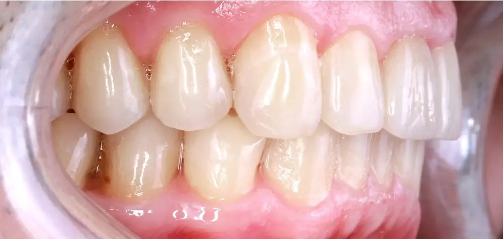 Скученность - Кейс 12 — боковой ракурс после лечения