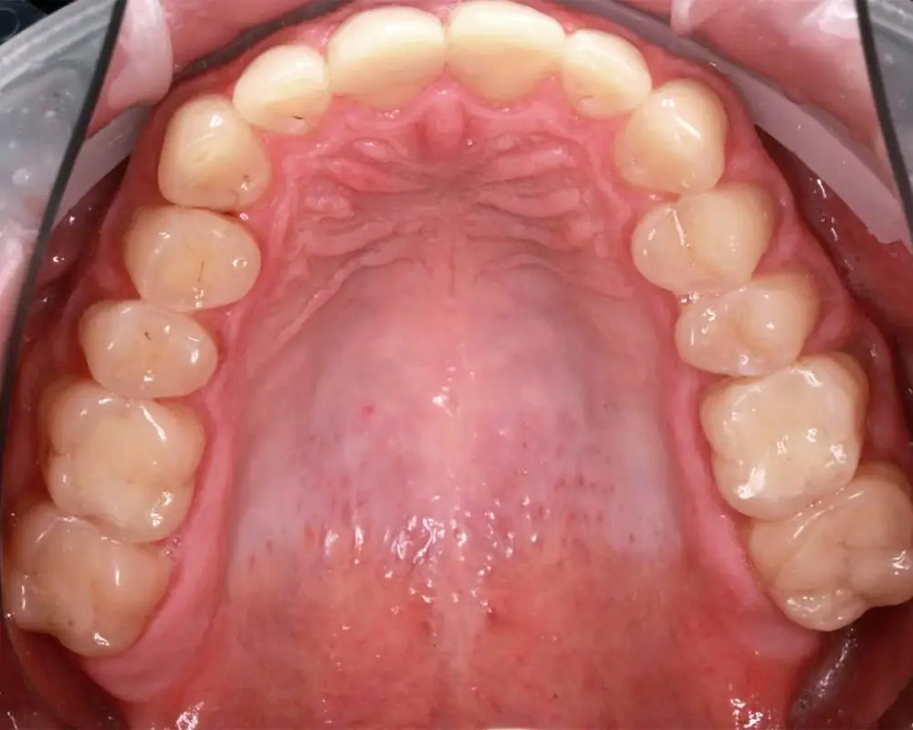 Скученность - Кейс 12 — верхняя челюсть до лечения