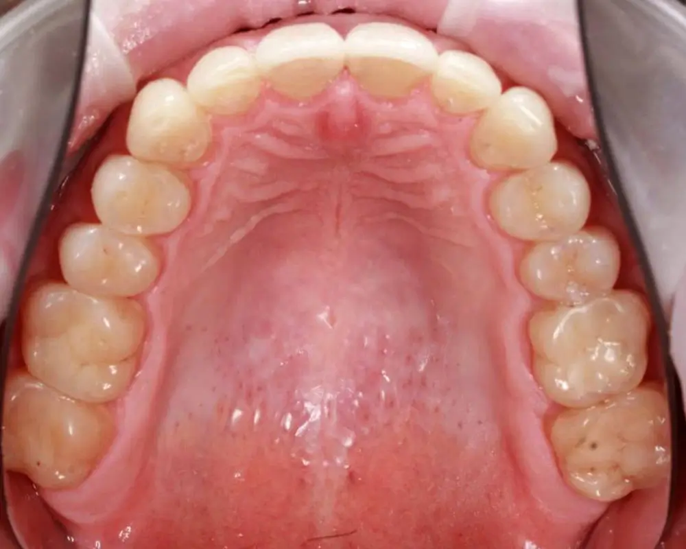 Скученность - Кейс 12 — верхняя челюсть после лечения