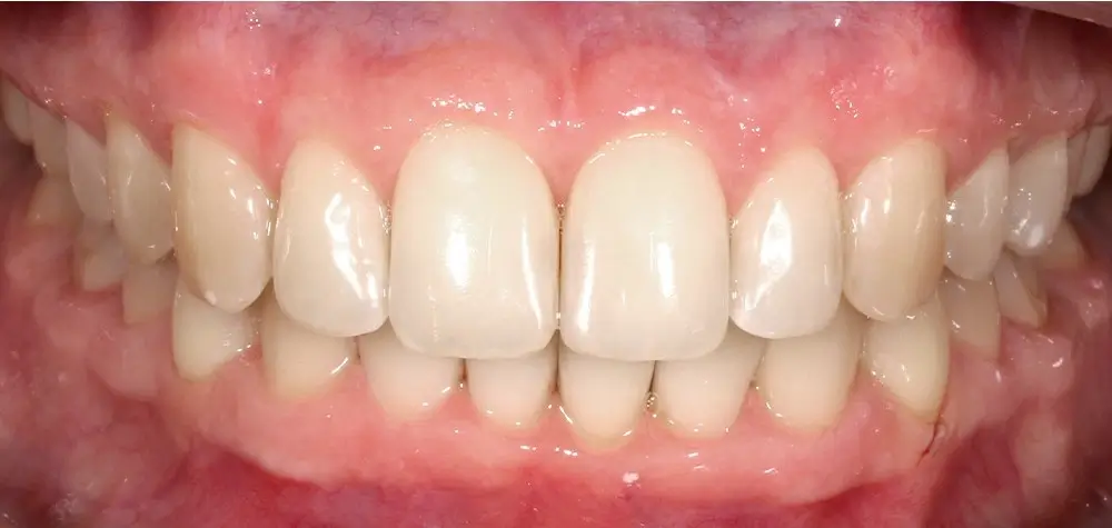 Скученность - Кейс 13 — вид спереди после лечения