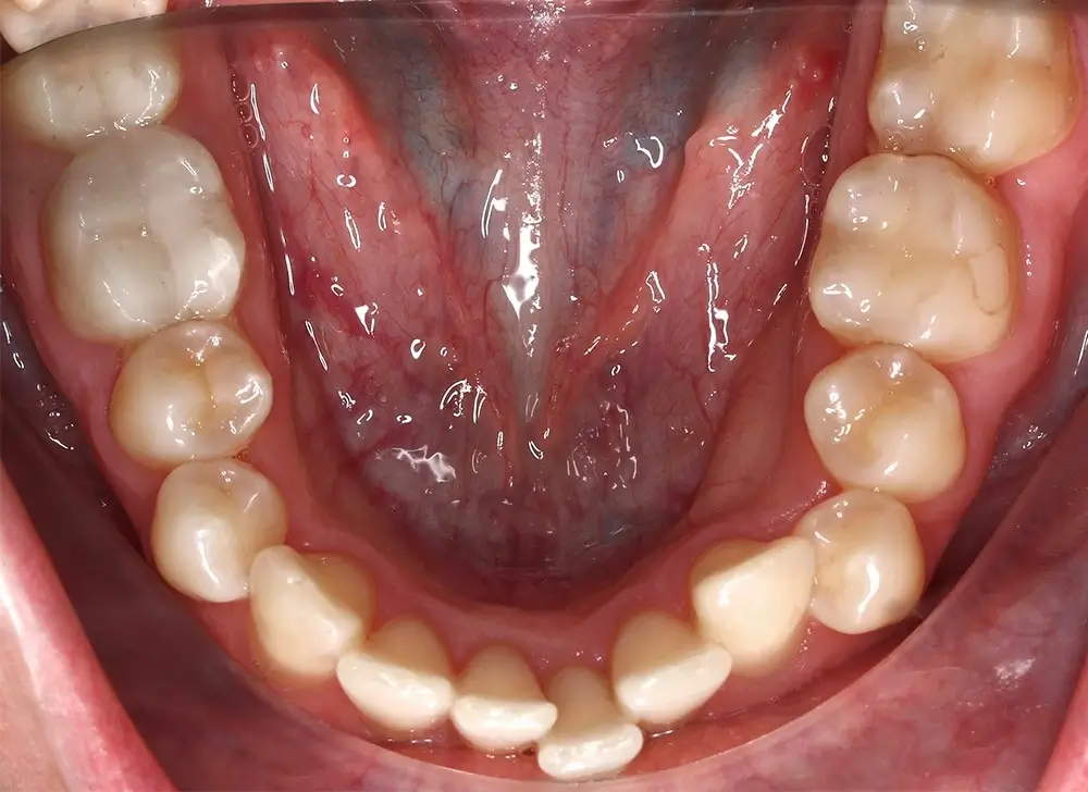 Скученность - Кейс 13 — нижняя челюсть до лечения
