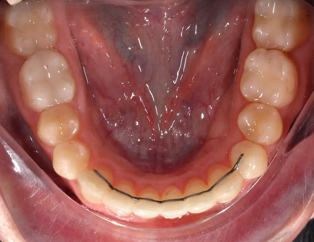 Скученность - Кейс 13 — нижняя челюсть после лечения