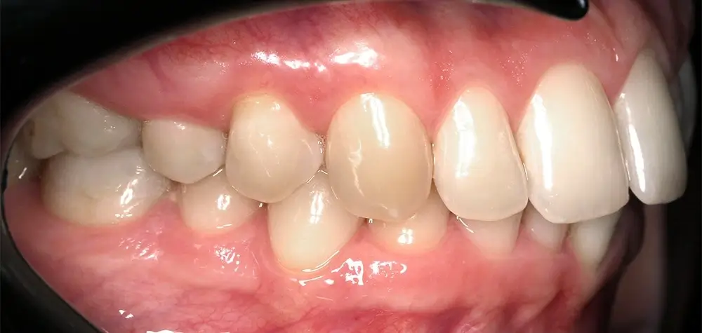 Скученность - Кейс 13 — боковой ракурс до лечения