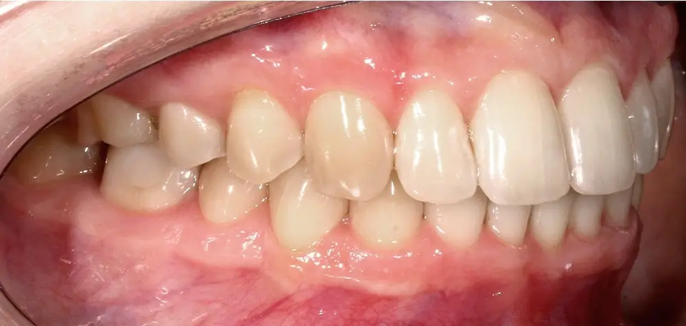 Скученность - Кейс 13 — боковой ракурс после лечения