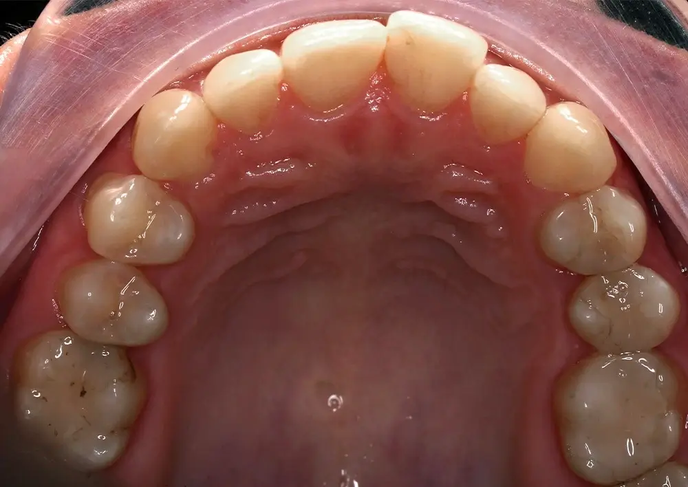 Скученность - Кейс 13 — верхняя челюсть до лечения