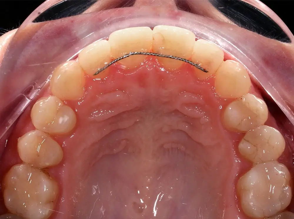 Скученность - Кейс 13 — верхняя челюсть после лечения