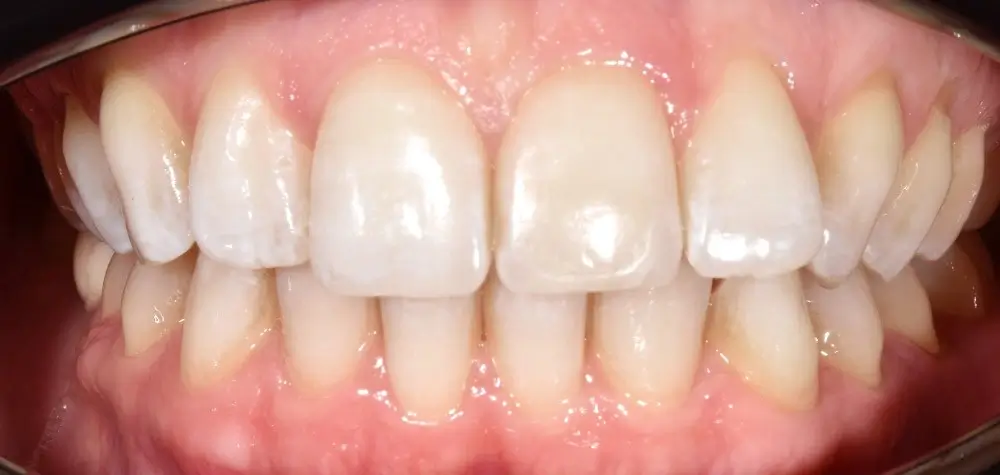 Скученность - Кейс 14 — фронтальный ракурс до лечения