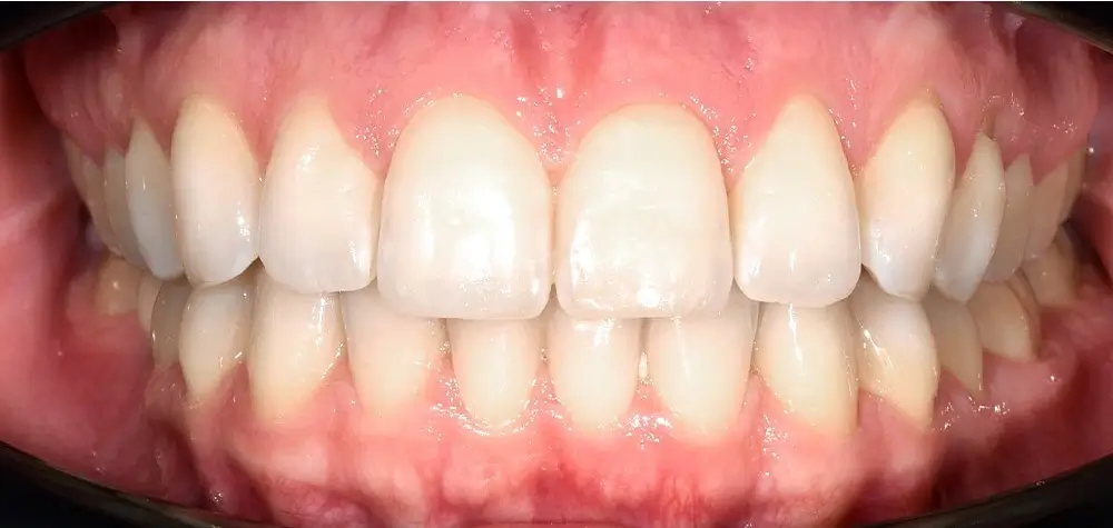 Скученность - Кейс 14 — фронтальный ракурс после лечения