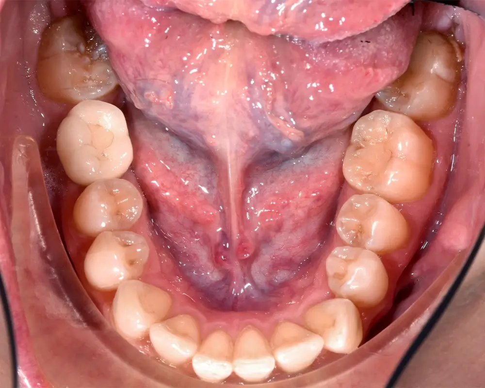 Скученность - Кейс 14 — нижняя челюсть до лечения