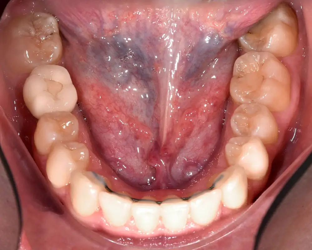 Скученность - Кейс 14 — нижняя челюсть после лечения