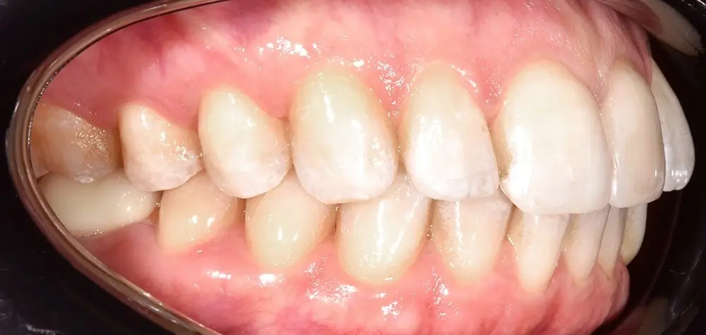 Скученность - Кейс 14 — боковой ракурс до лечения