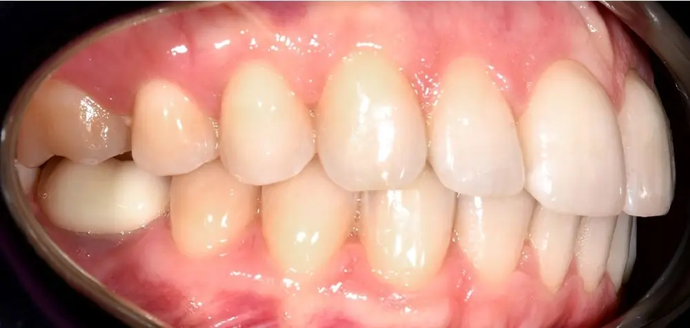 Скученность - Кейс 14 — боковой ракурс после лечения