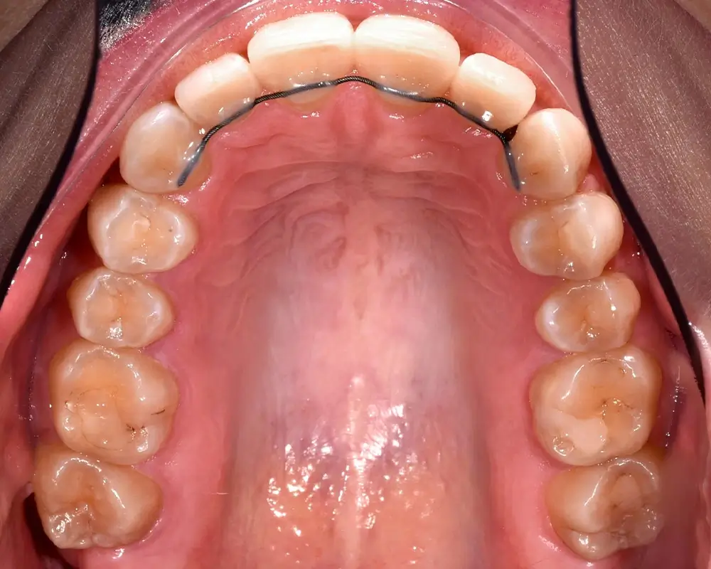 Скученность - Кейс 14 — верхняя челюсть после лечения