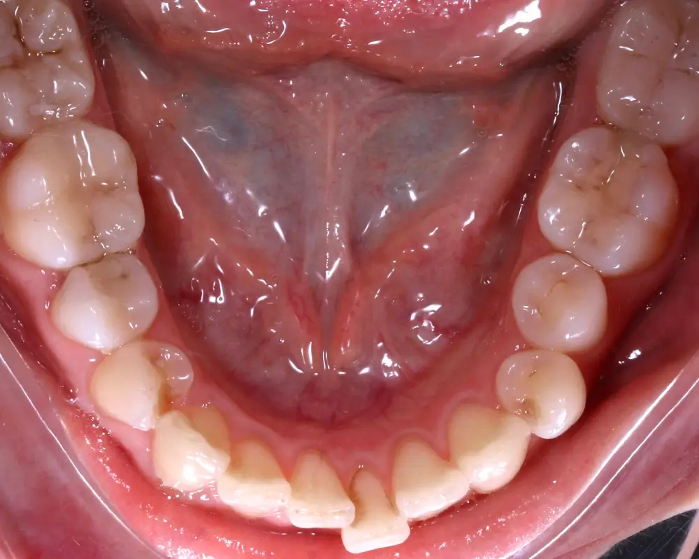 Скученность - Кейс 15 — нижняя челюсть до лечения