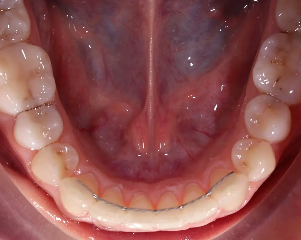 Скученность - Кейс 15 — нижняя челюсть после лечения