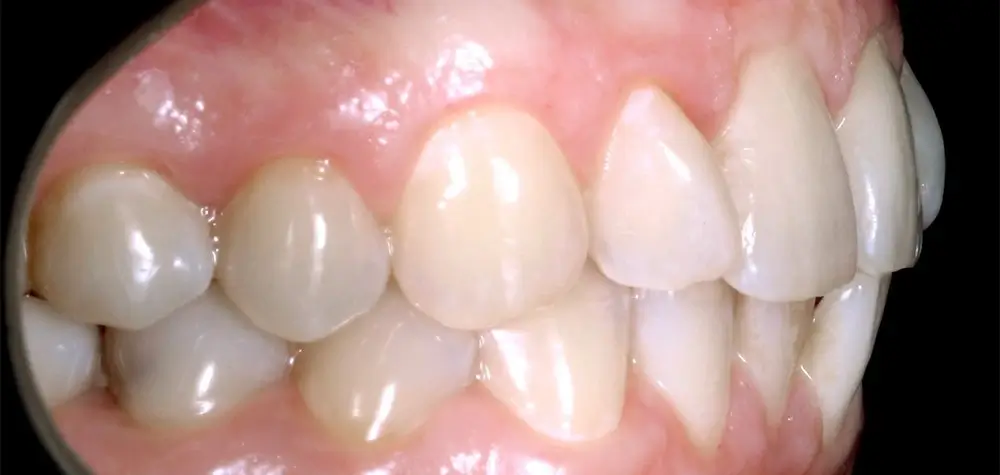 Скученность - Кейс 15 — боковой ракурс до лечения